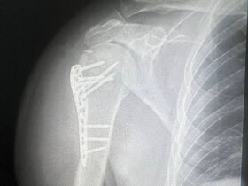 Рентген плечевого сустава