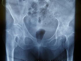 Сакроилеит