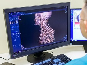 Шейный остеохондроз Шийний остеохондроз