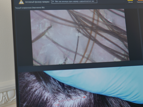 Стригущий лишай у детей