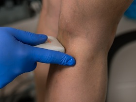 Телеангиэктазии