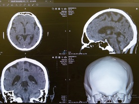 Транзиторная ишемическая атака (ТИА)