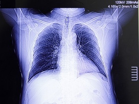 Тромбоэмболия легочной артерии (ТЭЛА) Тромбоемболія легеневої артерії (ТЕЛА)