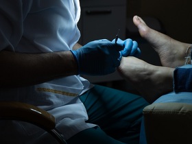 Видалення стрижневого мозоля