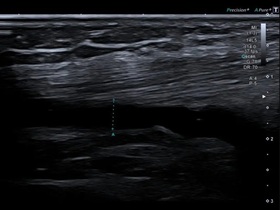 УЗИ коленного сустава