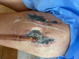 Вакуумное лечение ран (VAC-терапия)